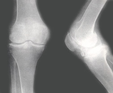 治疗骨质疏松症或关节炎