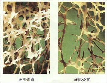 骨质疏松症的原因:骨骼中钙和蛋白枯竭