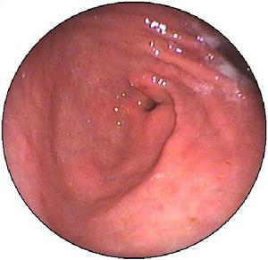 胃息肉过大癌变率高