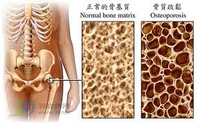 咖啡过量 易骨松