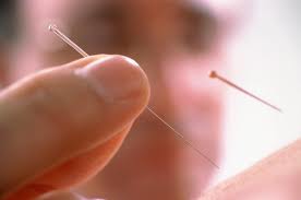 坐骨神经痛 试试针灸疗法