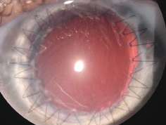 中国科学家有望研制出完整人工角膜