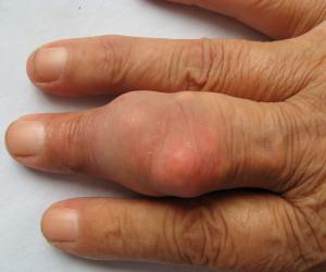 远离痛风需预防什么