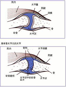 预防膝关节骨关节炎 从日常作息开始