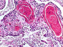 癌症专家进行临床试验 阿司匹林或能抗癌