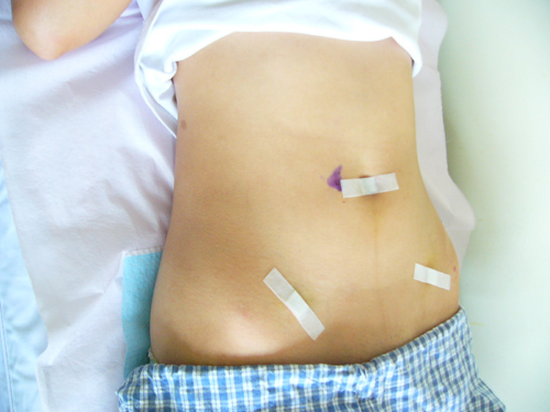 肠梗阻定性定位标准