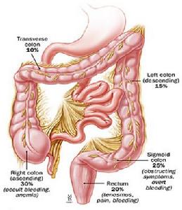 大肠癌倍增 港第二杀手