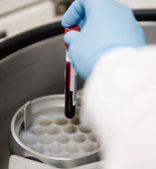 新法诊断卵巢癌 可降低30%误测率