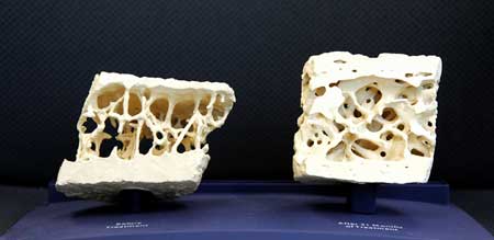 无声疾病：骨质疏松