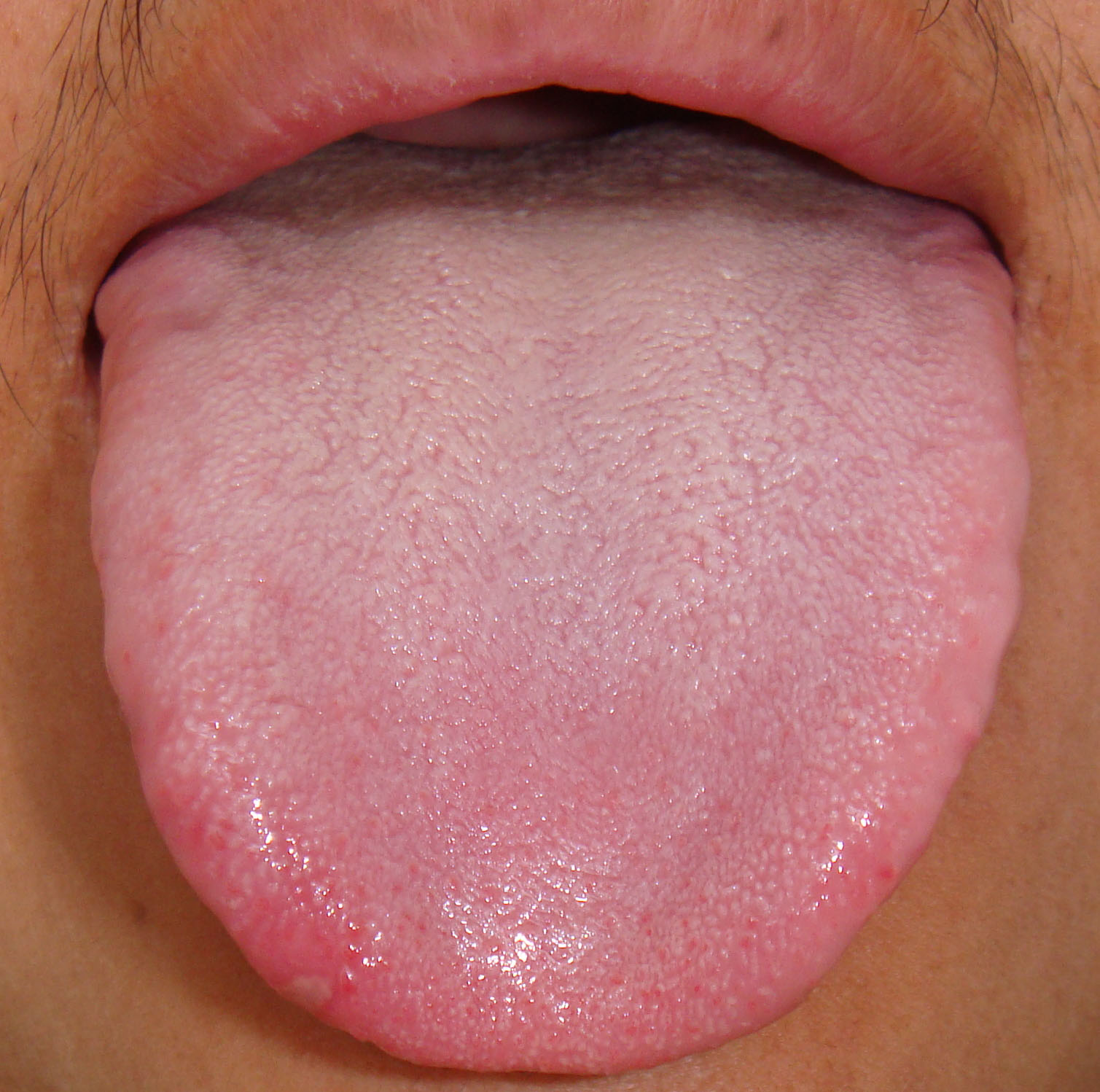 各种舌头表现透露身体状况